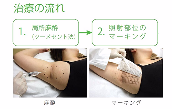 打ち漏れが少ない⼿順で施術