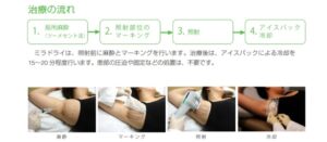 ミラドライ認定医によるメーカー推奨の施術手順