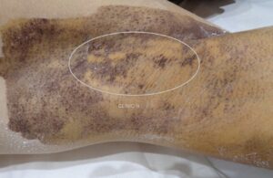ミラドライ　発汗テスト　当院実例集　他院ミラドライ術後　右脇