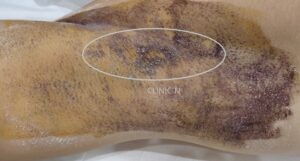 ミラドライ　発汗テスト　当院実例集　他院ミラドライ術後　右脇