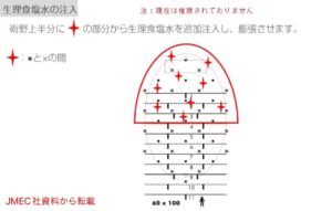 脇の局部麻酔