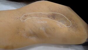 ミラドライ　発汗テスト　当院実例集　他院ミラドライ術後３症例目　