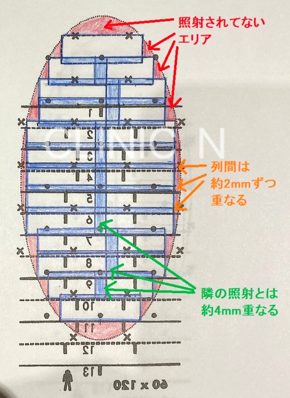 ミラドライのテンプレートは脇毛有毛部より1cm大きいものを選びましょう