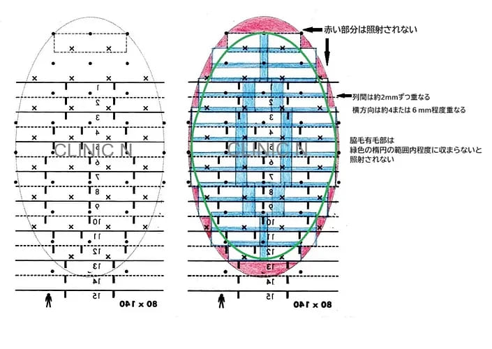 ミラドライ広範囲ダブル照射をミラドライ認定医が実例を交え解説