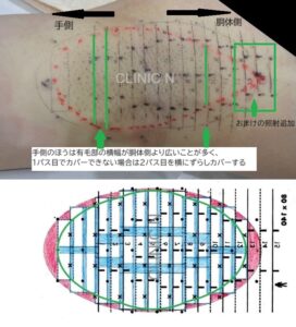 照射テンプレート見本