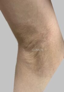 当院のミラドライ患者⑧　術後1週間　ダウンタイム中の脇の写真