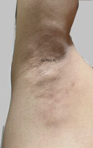当院のミラドライ患者10　術後2週間　ダウンタイム中の脇の写真　