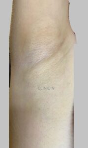 当院のミラドライ患者13　術後2週間　ダウンタイム中の脇の写真　