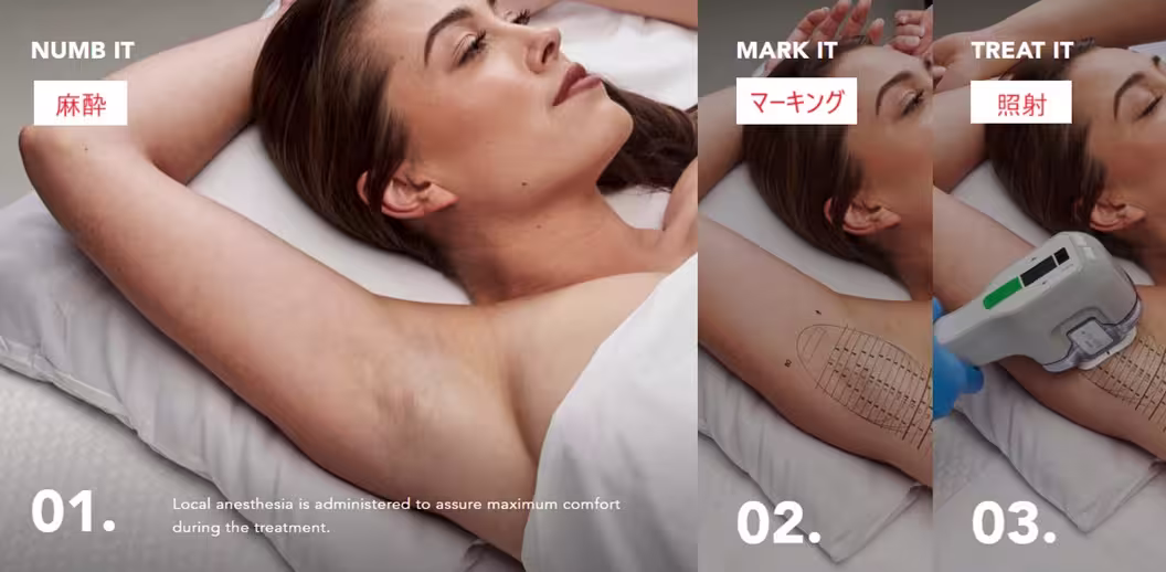 ミラドライは麻酔→マーキングが公式の施術法です