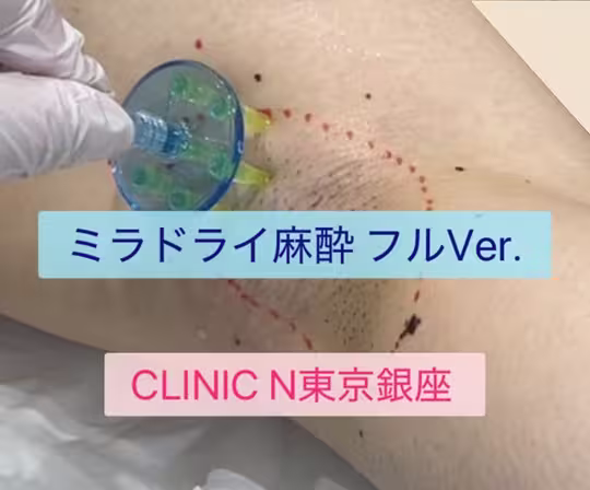 ミラドライ当院の麻酔方法の動画をUPしました！