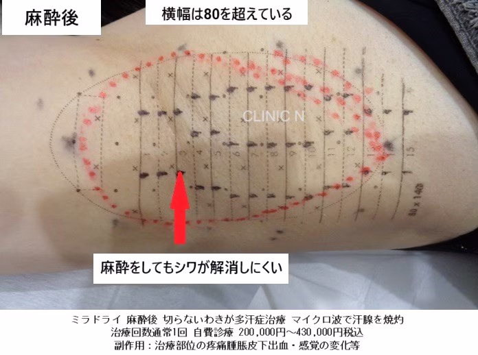 当院実例　ふくよか女性ミラドライ麻酔後の写真