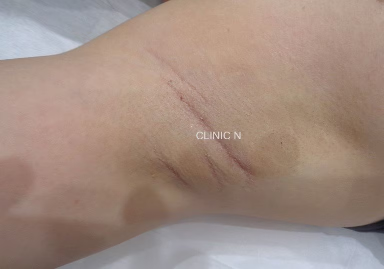ビューホット後の患者様　ミラドライ施術前の脇の写真
