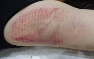 ミラドライ広範囲ダブル照射モニター 術後ダウンタイム 内出血の写真