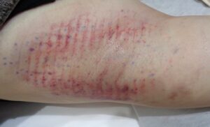 ミラドライ広範囲ダブル照射モニター 術後ダウンタイム 皮下出血の写真 ある程度付く方2人目