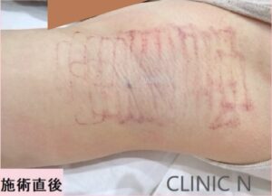 CLINIC N東京 ミラドライシングル照射モニター 脇写真