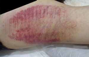 ミラドライ広範囲ダブル照射モニター 術後ダウンタイム 皮下出血強い方1人目の写真