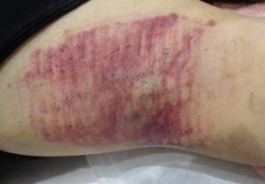 ミラドライ広範囲ダブル照射モニター 術後ダウンタイム 皮下出血強い方2人目の写真