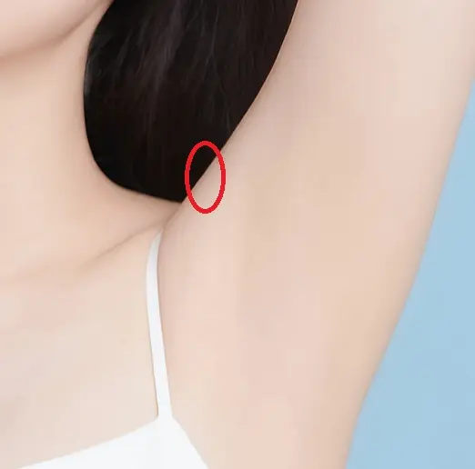 5年後に2回目のミラドライを行いました｜片脇のみ再照射症例・広範囲ダブル照射
