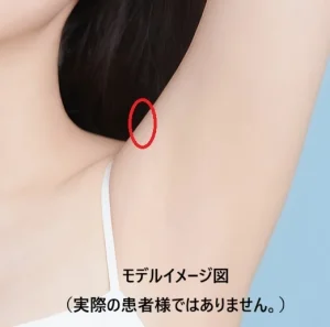 ミラドライ2回目 脇の再照射部位イメージ図
